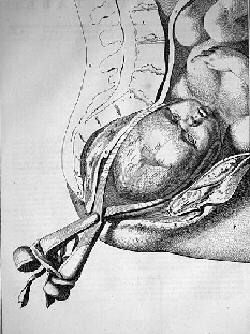 Abbildung einer Zangengeburt
